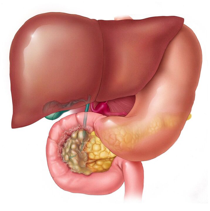 How to remove parasites from the liver